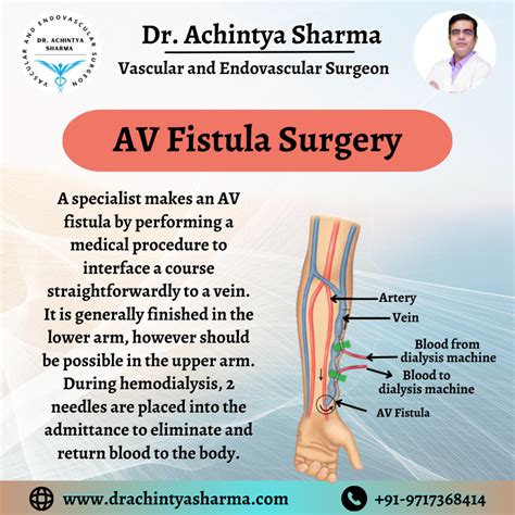 AV Fistula Surgery