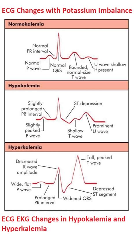 ECG/EKG Changes in Hypokalemia and Hyperkalemia - NCLEX Quiz