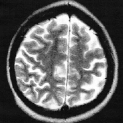 Axial SE T2 image: Diffuse brain atrophy particularly marked at the ...