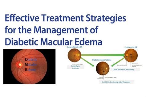 Diabetic Macular Edema & Treatment Strategies | OBN