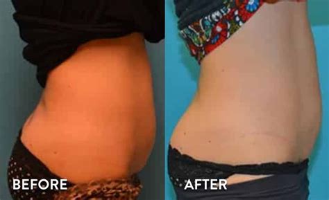 SculpSure Before and After Pictures | SculpSure Photo Gallery