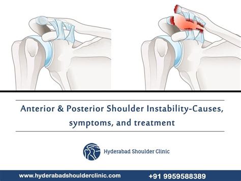 Anterior & Posterior Shoulder Instability – Causes, symptoms, and ...