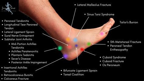 Top Of Foot Pain Diagram