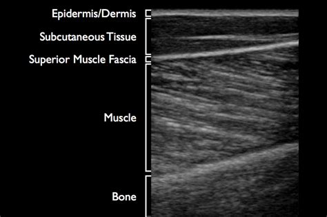 Ultrasound Leadership Academy: Intro to Musculoskeletal Ultrasound — EM ...