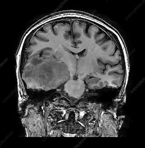 Glioblastoma Temporal Lobe, MRI - Stock Image - C039/3940 - Science ...