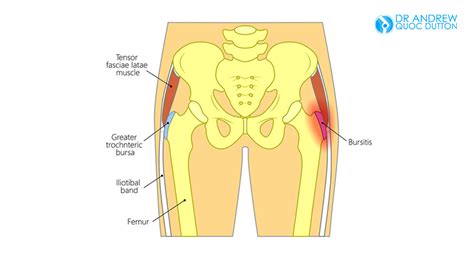 Right Hip Bone Pain Causes You Should Know - DeeahZone | Informasi dan Tips