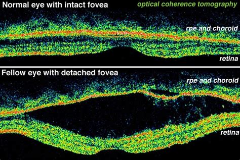 Figure 31b, [Optical coherence tomography (OCT) images...]. - Webvision ...