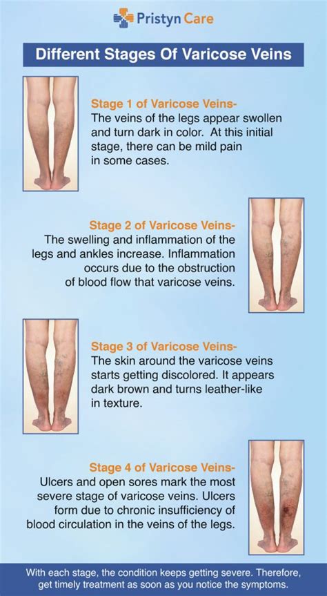 Varicose Veins Stages - Pristyn Care