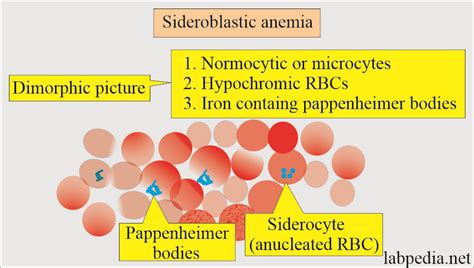 Sideroblastic Anemia Pathophysiology