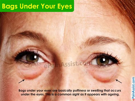 What Causes Bags Under Your Eyes and How To Get Rid of it?