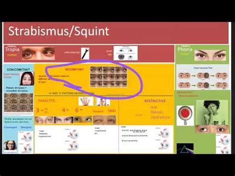 Ophthalmology 352 Strabismus Squint Difference Heterotropia ...