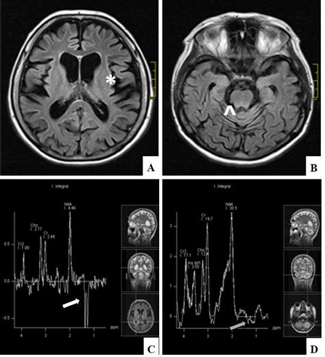 Diffuse cerebral (*) (A) and cerebellar atrophy (^) (B) on MRI, FLAIR ...