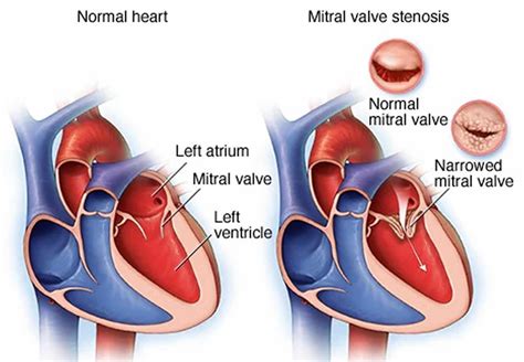 Mitral stenosis causes, symptoms, diagnosis, treatment & prognosis