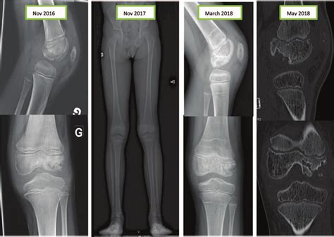 Limb-length discrepancy and chondropathy after a septic arthritis of ...