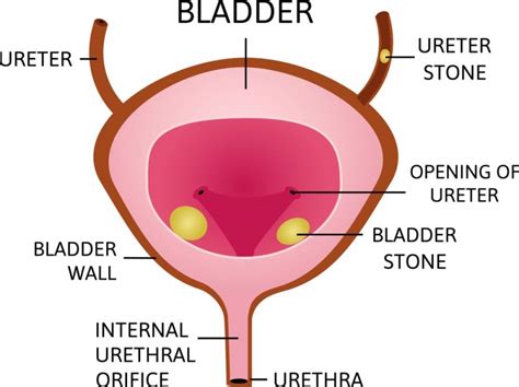 Urinary Bladder Stone Treatment in Pune | Dr. Irfan Shaikh