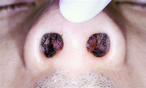 Nasal Septal Abscess Causes Symptoms Ddx Complications | SexiezPicz Web ...