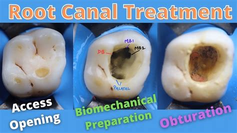 Root Canal Treatment in Maxillary First Permanent Molar 🟠 How to locate ...