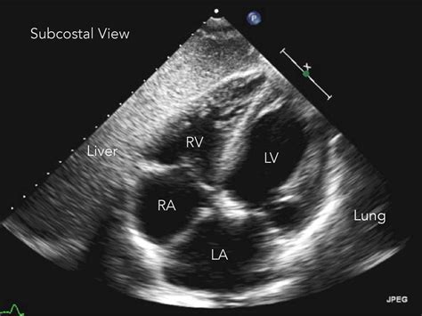 Subxiphoid Ultrasound