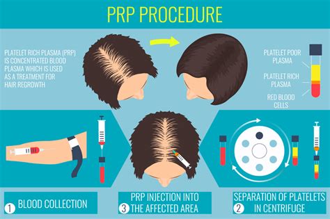 PRP Therapy For Hair Loss - Mollura Hair Restoration