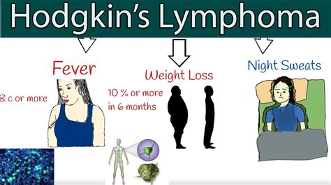 Hodgkin's lymphoma (Hodgkin's disease) - Symptoms and treatment. How to ...