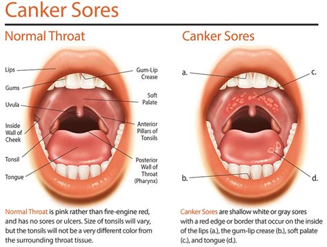 Canker-Rid Review | HubPages