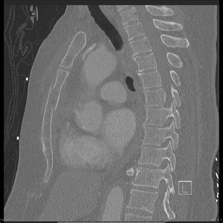 Sternal fracture | Radiology Reference Article | Radiopaedia.org