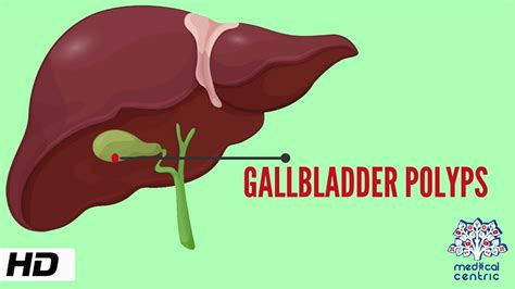 Gallbladder Polyp, Causes, Signs And Symptoms, Diagnosis, 44% OFF