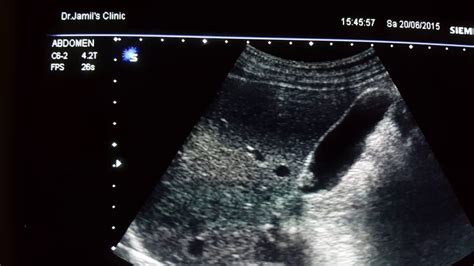 Gallbladder Polyp Ultrasound