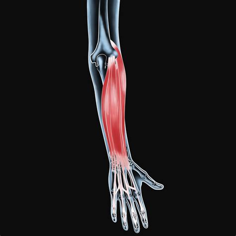 Wrist Extensor Muscle Injury Treatments - Pushing Through Pain