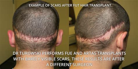 FUE Hair Transplantation – Before and After Pictures * | Dr Turowski ...