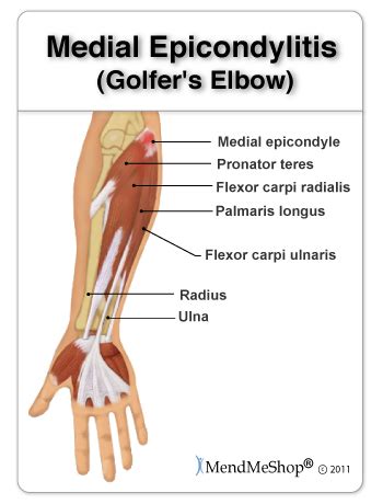 Golfers Elbow Causes