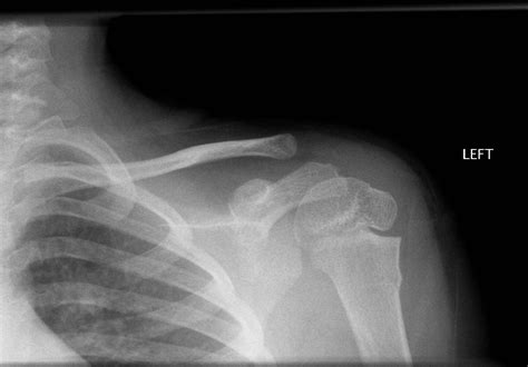 Left Humerus Fracture