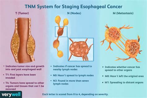 Esophageal Cancer Staging: Grades, Staging, Prognosis