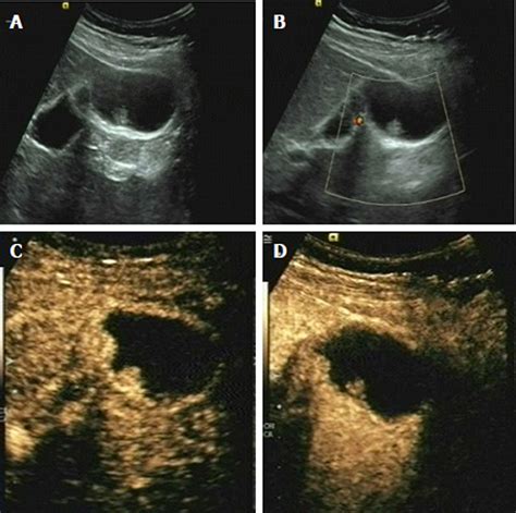 Gallbladder Polyps Ultrasound