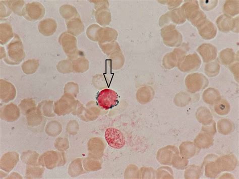 Cureus | Reversible Myelosuppresion With Prolonged Usage of Linezolid ...