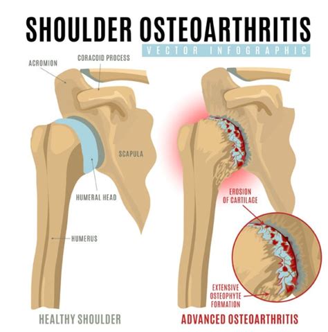 Shoulder Arthritis Treatment | Las Vegas, Lake Havasu, Mesquite Nevada