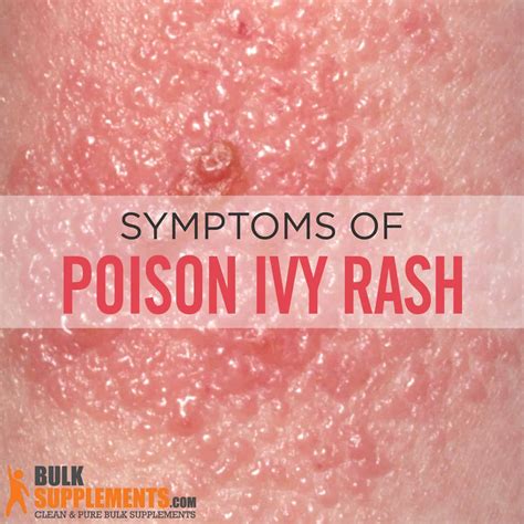 Poison Ivy Rash Symptoms Stages