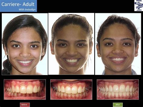 Invisalign Vs Braces Results