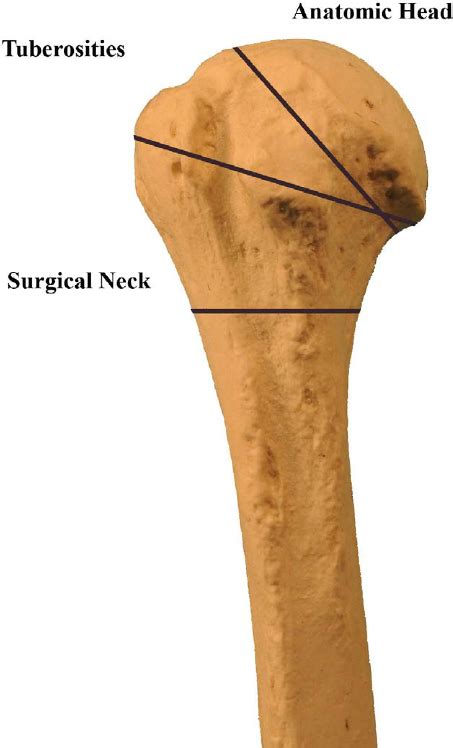 The common zones of injury in the humerus: the anatomic head ...