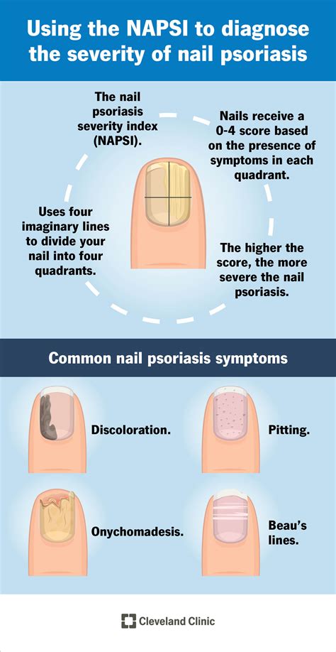 Onycholysis Psoriasis