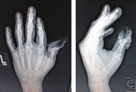 Radiographs of the distal thumb crush-avulsion revealing distal phalanx ...