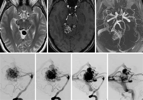 Arteriovenous Malformation: What the Patient Needs to Know | Aaron ...