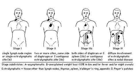 Hodgkin’s Lymphoma - Staging and Prognostic Factors | Epomedicine