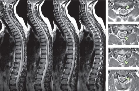 Cervical Spine Mri Ms