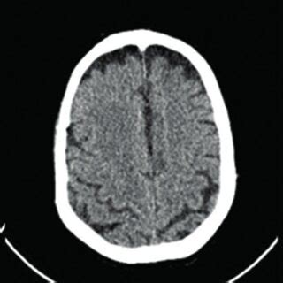 a: Moderate atrophy of medial temporal lobe and mild atrophy of frontal ...