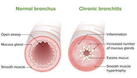 Obstructive lung disease: Symptoms, diagnosis, and treatment - Lifeline ...