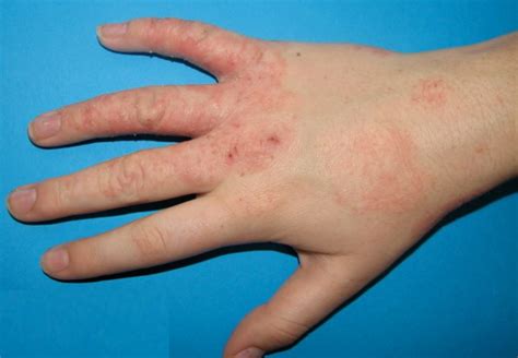 How To Treat Eczema On Hands - Causes And Symptoms Of Hand Eczema ...