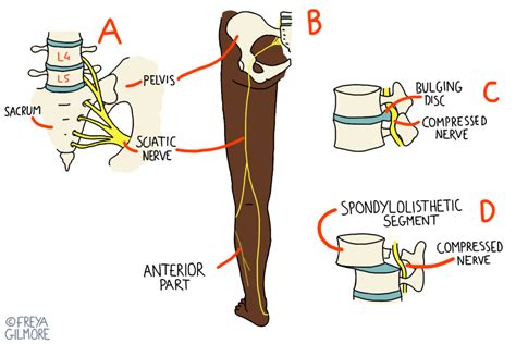 Sciatica and Piriformis Syndrome - Beth Forrest Osteopathy