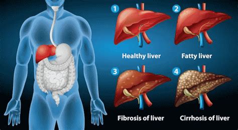 Liver Cirrhosis Causes Symptoms Diagnosis Treatment Medicine My | The ...