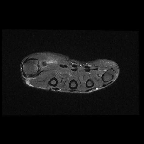 Extensor Pollicis Longus Mri